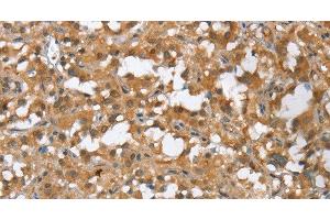 Immunohistochemistry of paraffin-embedded Human thyroid cancer tissue using MMP12 Polyclonal Antibody at dilution of 1:60 (MMP12 抗体)