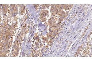 ABIN6266830 at 1/100 staining Human Melanoma tissue by IHC-P. (COL4A1 抗体)