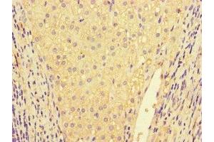 Immunohistochemistry of paraffin-embedded human liver cancer using ABIN7156891 at dilution of 1:100 (IL32 抗体  (AA 31-234))
