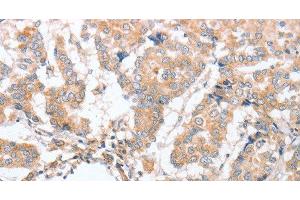 Immunohistochemistry of paraffin-embedded Human breast cancer tissue using PARD6A Polyclonal Antibody at dilution 1:60 (PARD6A 抗体)