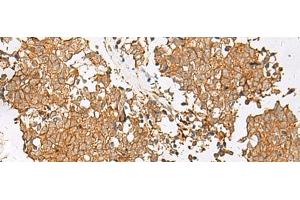 Immunohistochemistry of paraffin-embedded Human lung cancer tissue using GSTM2 Polyclonal Antibody at dilution of 1:50(x200) (GSTM2 抗体)