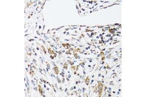 Immunohistochemistry of paraffin-embedded human uterine cancer using DHRS2 antibody. (DHRS2 抗体  (AA 1-300))