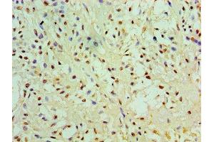 Immunohistochemistry of paraffin-embedded human breast cancer using ABIN7151444 at dilution of 1:100 (PHD1 抗体  (AA 283-407))