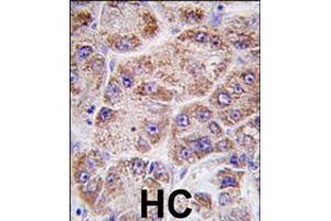 Formalin-fixed and paraffin-embedded human hepatocellular carcinoma reacted with FDPS polyclonal antibody  , which was peroxidase-conjugated to the secondary antibody, followed by DAB staining . (FDPS 抗体  (AA 338-453))