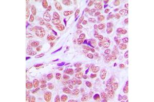 Immunohistochemical analysis of PCAF staining in human breast cancer formalin fixed paraffin embedded tissue section.