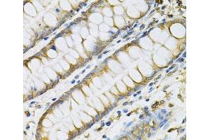 Immunohistochemistry of paraffin-embedded Human colon using PDGFB Polyclonal Antibody at dilution of 1:100 (40x lens). (PDGFB 抗体)