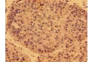 Immunohistochemistry of paraffin-embedded human liver cancer using ABIN7162766 at dilution of 1:100 (GDF15 抗体  (AA 16-143))