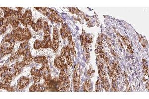ABIN6278311 at 1/100 staining Human liver cancer tissue by IHC-P. (ITGA6 抗体  (N-Term))