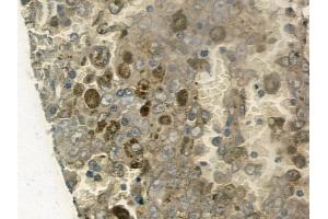 ABIN6260308 and ABIN6272258 at 1/100 staining human melanoma by IHC-P.