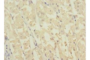 Immunohistochemistry of paraffin-embedded human gastric cancer using ABIN7162039 at dilution of 1:100 (NME3 抗体  (AA 20-169))