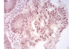 Immunohistochemical analysis of paraffin-embedded rectum cancer tissues using CBX2 mouse mAb with DAB staining. (CBX2 抗体  (AA 402-525))