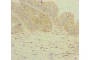 Immunohistochemistry of paraffin-embedded human colon cancer using ABIN7154305 at dilution of 1:100 (GORASP2 抗体  (AA 353-452))