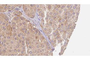 ABIN6277537 at 1/100 staining Human Melanoma tissue by IHC-P. (LUM 抗体  (N-Term))