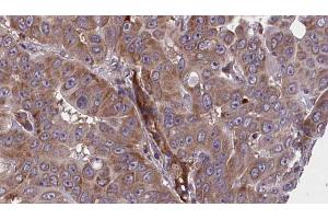 ABIN6273609 at 1/100 staining Human liver cancer tissue by IHC-P. (BIN2 抗体  (Internal Region))