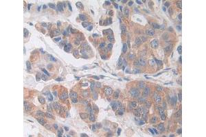 IHC-P analysis of breast cancer tissue, with DAB staining. (CDK18 抗体  (AA 144-425))