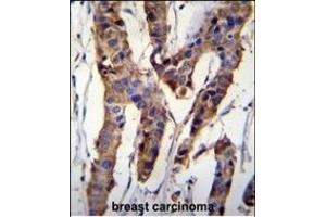 ZBT24 Antibody (N-term) (ABIN655829 and ABIN2845247) immunohistochemistry analysis in formalin fixed and paraffin embedded human breast carcinoma followed by peroxidase conjugation of the secondary antibody and DAB staining. (ZBTB24 抗体  (N-Term))