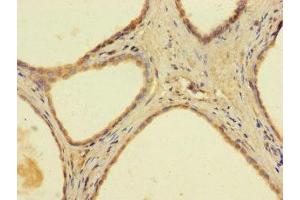 Immunohistochemistry of paraffin-embedded human prostate cancer using ABIN7144667 at dilution of 1:100 (AADAC 抗体  (AA 24-399))