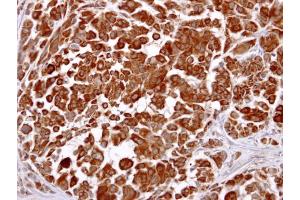IHC-P Image LHR antibody [C3], C-term detects LHR protein at cytosol on human lung carcinoma by immunohistochemical analysis. (LHCGR 抗体  (C-Term))