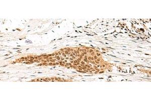 Immunohistochemistry of paraffin-embedded Human esophagus cancer tissue using MDFI Polyclonal Antibody at dilution of 1:55(x200) (MDFI 抗体)
