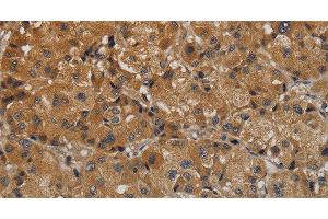 Immunohistochemistry of paraffin-embedded Human liver cancer tissue using TAB1 Polyclonal Antibody at dilution 1:40 (TAB1 抗体)