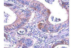 IHC-P Image LDH-B antibody detects LDHB protein at cytosol on human gastric cancer by immunohistochemical analysis. (LDHB 抗体)