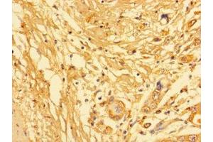 Immunohistochemistry of paraffin-embedded human pancreatic cancer using ABIN7157217 at dilution of 1:100 (Kallikrein 6 抗体  (AA 22-244))
