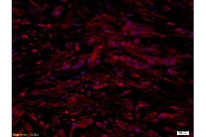 Formalin-fixed and paraffin embedded human gastric cancer labeled with Anti-UCP-1 Polyclonal Antibody, Unconjugated (ABIN675413) at 1:300 followed by conjugation to the secondary antibody and DAPI staining (UCP1 抗体  (AA 101-200))