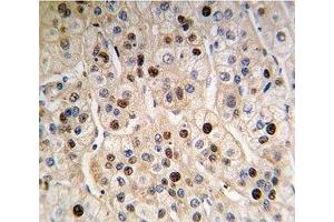 IHC analysis of FFPE human hepatocarcinoma tissue stained with anti-PCNA antibody (PCNA 抗体  (AA 89-117))