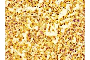 Immunohistochemistry of paraffin-embedded human colon cancer using nme1HU at dilution of 1:100 (HIST1H1E 抗体)