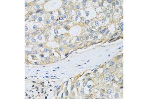 Immunohistochemistry of paraffin-embedded human breast cancer using SLC3A2 antibody. (SLC3A2 抗体  (AA 360-529))