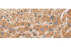 Immunohistochemistry of paraffin-embedded Human liver cancer tissue using PDHA1 Polyclonal Antibody at dilution of 1:50(x200) (PDHA1 抗体)