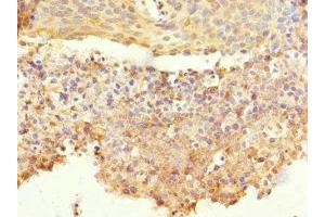 Immunohistochemistry of paraffin-embedded human cervical cancer using ABIN7148605 at dilution of 1:100