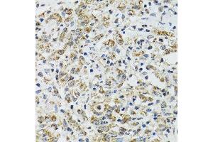 Immunohistochemistry of paraffin-embedded human uterine cancer using TXN2 antibody. (TXN2 抗体  (AA 1-166))