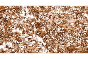 Immunohistochemistry of paraffin-embedded Human renal cancer tissue using SLC9A3R2 Polyclonal Antibody at dilution 1:40 (SLC9A3R2 抗体)