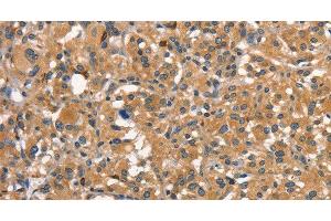 Immunohistochemistry of paraffin-embedded Human thyroid cancer using DNM2 Polyclonal Antibody at dilution of 1:40 (DNM2 抗体)