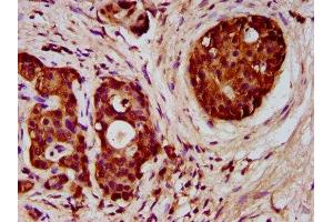 IHC image of ABIN7152390 diluted at 1:300 and staining in paraffin-embedded human pancreatic cancer performed on a Leica BondTM system. (FCHO1 抗体  (AA 45-180))