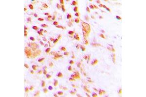 Immunohistochemical analysis of ETV4 staining in human lung cancer formalin fixed paraffin embedded tissue section. (ETV4 抗体  (Center))