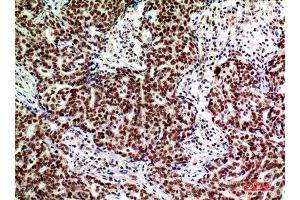 Immunohistochemistry (IHC) analysis of paraffin-embedded Human Breast Cancer, antibody was diluted at 1:200. (ACER2 抗体)