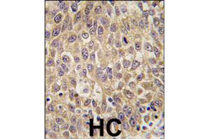 Formalin-fixed and paraffin-embedded human hepatocellular carcinoma reacted with AFP polyclonal antibody  , which was peroxidase-conjugated to the secondary antibody, followed by DAB staining. (alpha Fetoprotein 抗体  (N-Term))