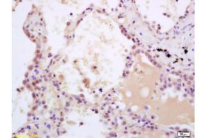 Formalin-fixed and paraffin embedded human lung carcinoma labeled with Rabbit Anti phospho-SHC(Tyr239/240) Polyclonal Antibody, Unconjugated (ABIN745973) at 1:200 followed by conjugation to the secondary antibody and DAB staining