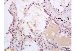 Formalin-fixed and paraffin embedded human lung carcinoma labeled with Rabbit Anti phospho-SHC(Tyr239/240) Polyclonal Antibody, Unconjugated (ABIN745973) at 1:200 followed by conjugation to the secondary antibody and DAB staining (SHC1 抗体  (pTyr349, pTyr350))