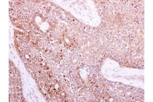 IHC-P Image NOX1 antibody detects NOX1 protein at cytoplasm on human lung carcinoma by immunohistochemical analysis. (NOX1 抗体)
