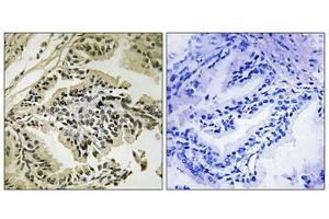 Immunohistochemical analysis of paraffin-embedded human prostate carcinoma tissue using PEK/PERK (Phospho-Thr982) antibody (left)or the same antibody preincubated with blocking peptide (right). (PERK 抗体  (pThr981))