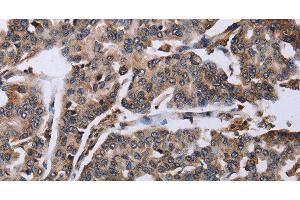 Immunohistochemistry of paraffin-embedded Human breast cancer tissue using DDX11 Polyclonal Antibody at dilution 1:30 (DDX11 抗体)