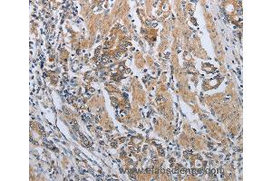 Immunohistochemistry of Human lung cancer using PDCD1 Polyclonal Antibody at dilution of 1:50 (PD-1 抗体)
