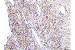 Formalin-fixed and paraffin embedded human cervical carcinoma labeled with Anti APE/Girdin Polyclonal Antibody, Unconjugated  at 1:200 followed by conjugation to the secondary antibody and DAB staining (Girdin 抗体  (AA 1401-1500))