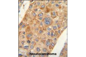 AMACR antibody immunohistochemistry analysis in formalin fixed and paraffin embedded human hepatocarcinoma followed by peroxidase conjugation of the secondary antibody and DAB staining.