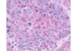Anti-GRPR antibody IHC of human Lung, Non-Small Cell Carcinoma. (GRPR 抗体  (Extracellular Domain))