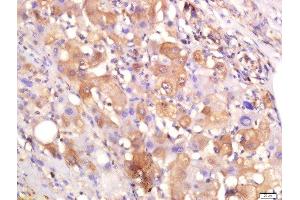 Paraformaldehyde-fixed, paraffin embedded human liver cancer, Antigen retrieval by boiling in sodium citrate buffer (pH6) for 15min, Block endogenous peroxidase by 3% hydrogen peroxide for 30 minutes, Blocking buffer (normal goat serum) at 37°C for 20min, Antibody incubation with Rabbit Anti-Arginase 1 Polyclonal Antibody, Unconjugated  at 1:200 overnight at 4°C, followed by a conjugated secondary and DAB staining. (Liver Arginase 抗体  (AA 151-220))