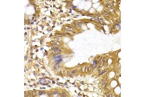 Immunohistochemistry of paraffin-embedded human colon cancer using IRF6 antibody at dilution of 1:200 (400x lens). (IRF6 抗体)